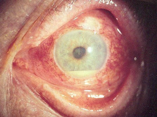 Uveitis