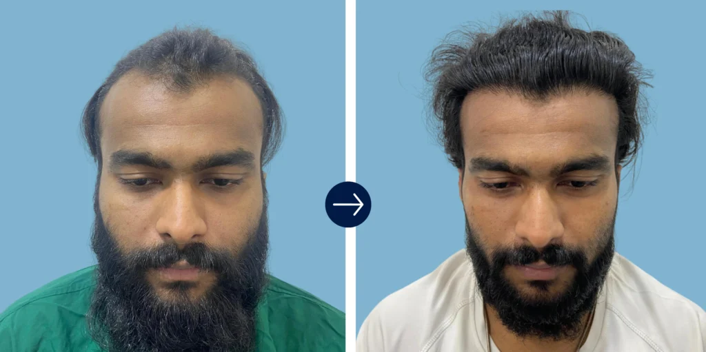 Results - Alloroots Hair Transplant Clinic - India's Best Hair Transplant Services