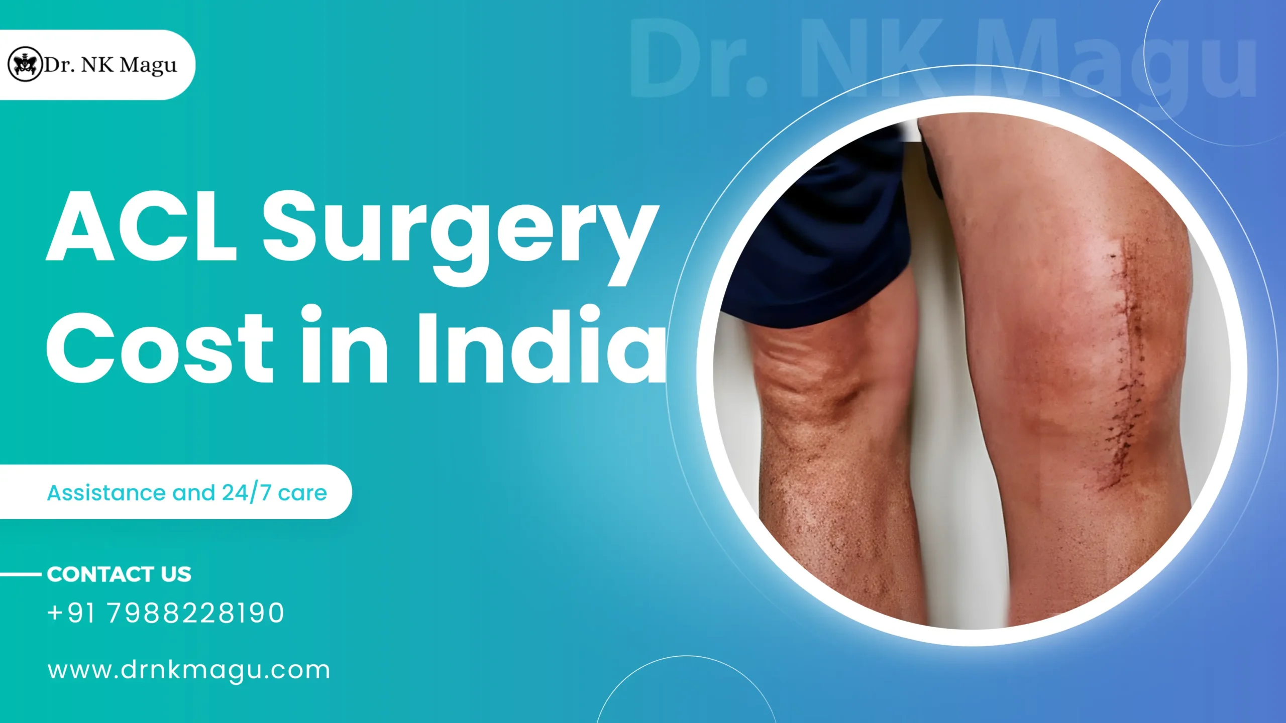 ACL Surgery Cost in India