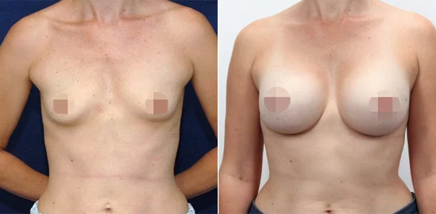 Before and after breast augmentation age 34, 5'0" 114 lbs, 34A to 34B at Ditesheim Cosmetic Surgery Charlotte NC clinic