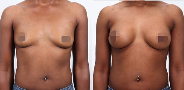 Breast augmentation results, age 44, 5'7" 120 lbs, bra size change 36B to 36C, Ditesheim Cosmetic Surgery Charlotte NC