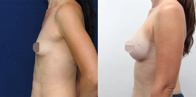Breast implant results showing restored fullness and youthful contour at Ditesheim Cosmetic Surgery.