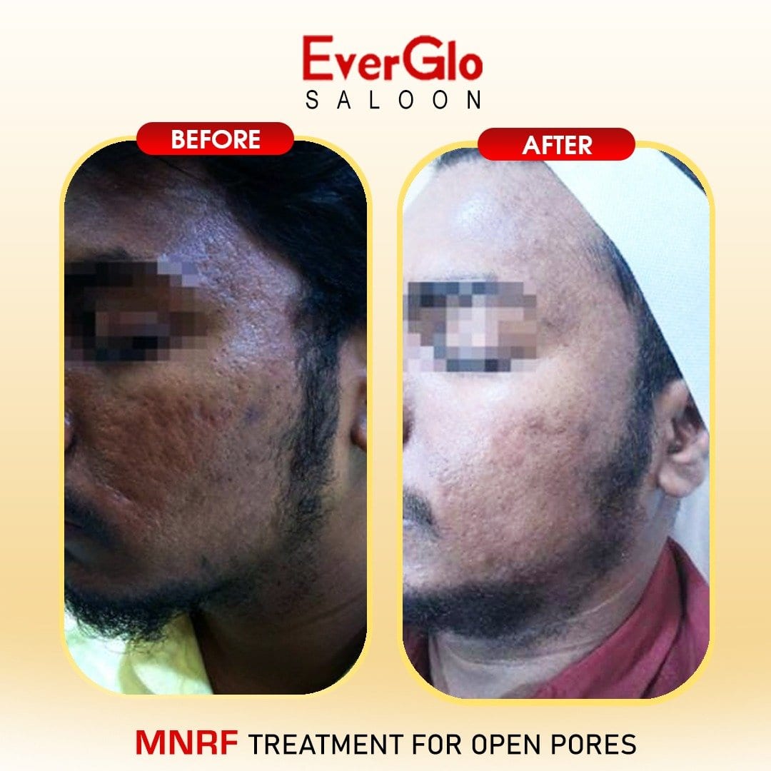 Open Pores Mnrf