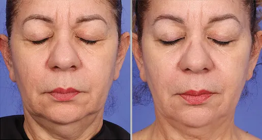 XERF before and after — male jawline definition result