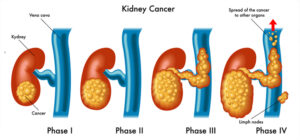 Kidney Cancer Prognosis