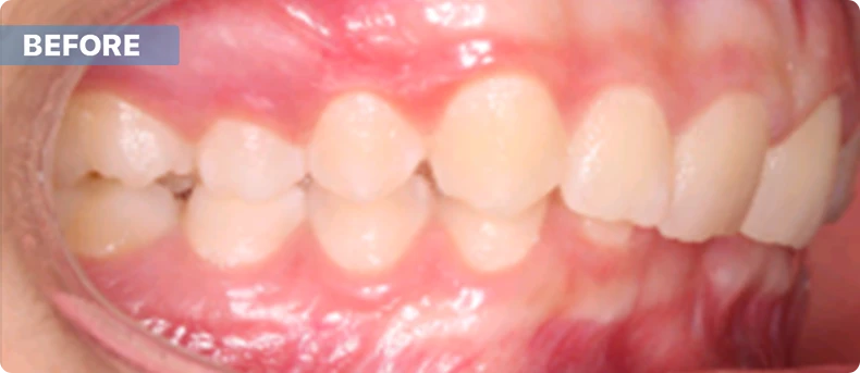 Before image of teeth showing misalignment and gum condition, related to orthodontics and dental care at Plano Top Dental.