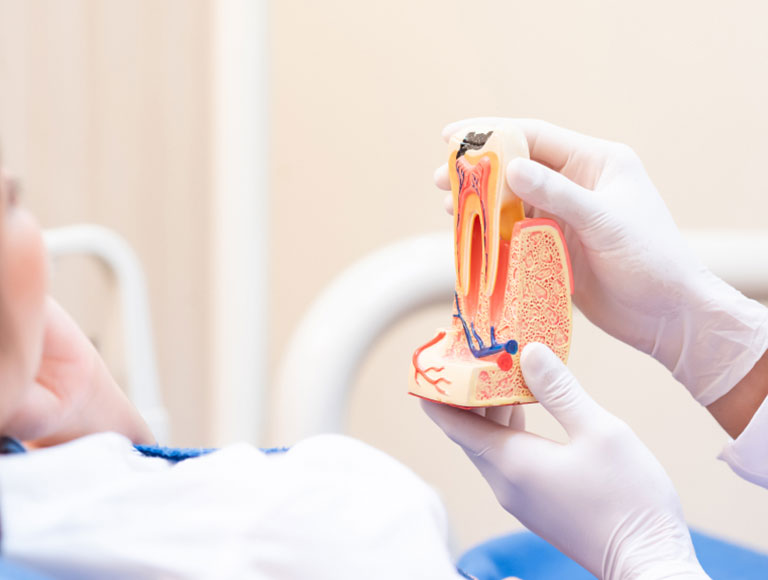 Root Canal