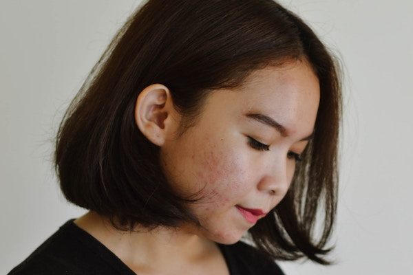 Acne and Rosacea