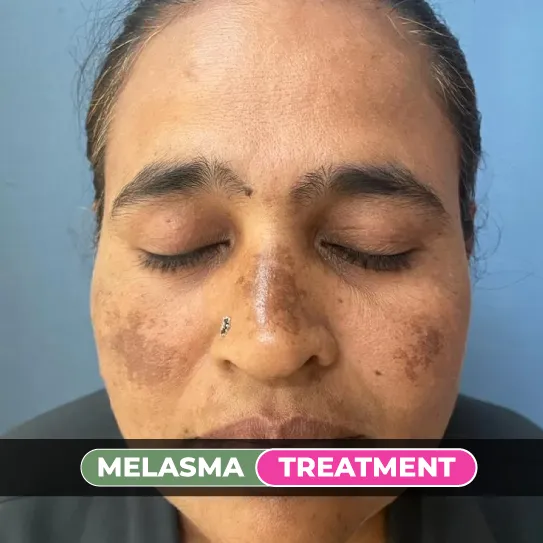 Melasma treatment for facial pigmentation and skin discoloration