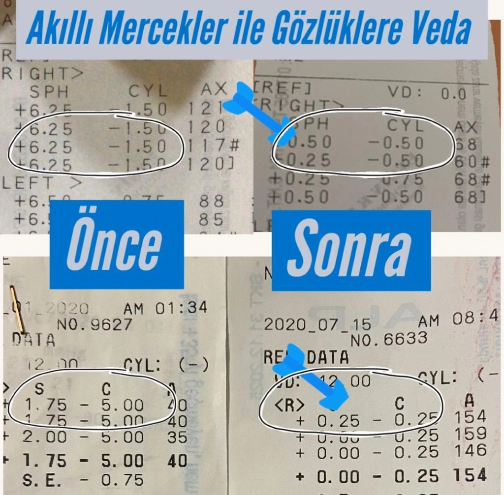 Akıllı Lens 2 Akıllı Lens