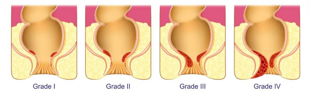 Hemorrhoids grades